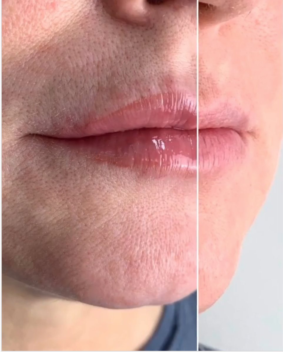 Alternative Lippenunterspritzung 
